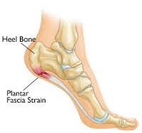 plantar faciitis